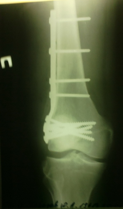 Изображение - Артроскопия коленного сустава где лучше делать 1469183579236035030