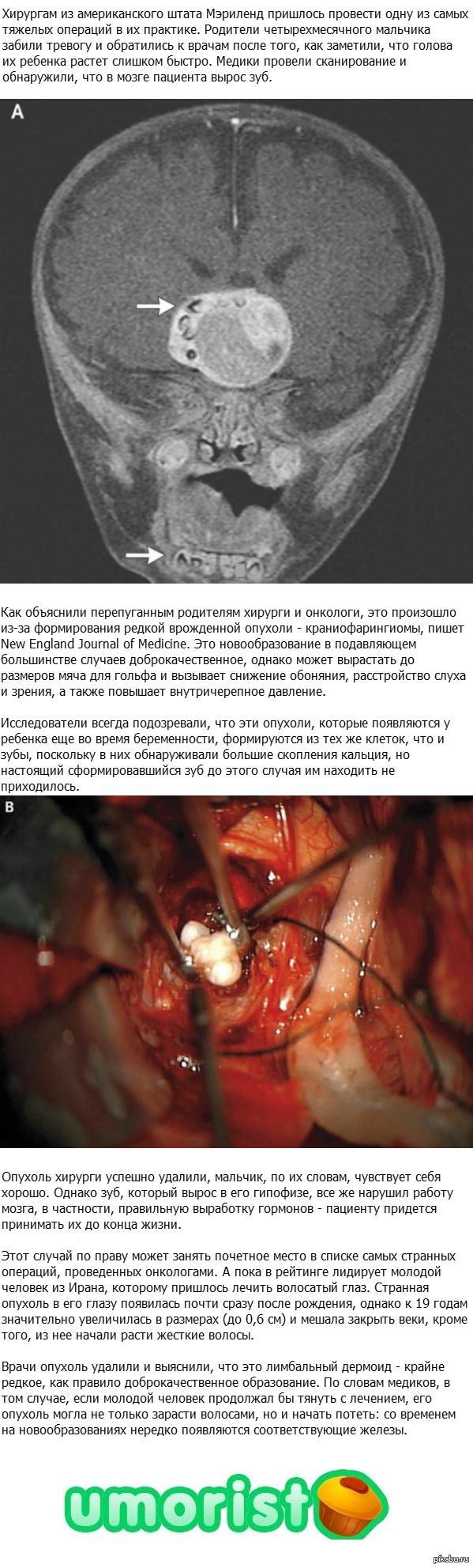 В мозге у мальчика вырос зуб | Пикабу