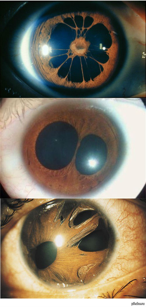 3 зрачка. Колобома радужной оболочки глаза. Пупула дуплекс заболевание глаз.