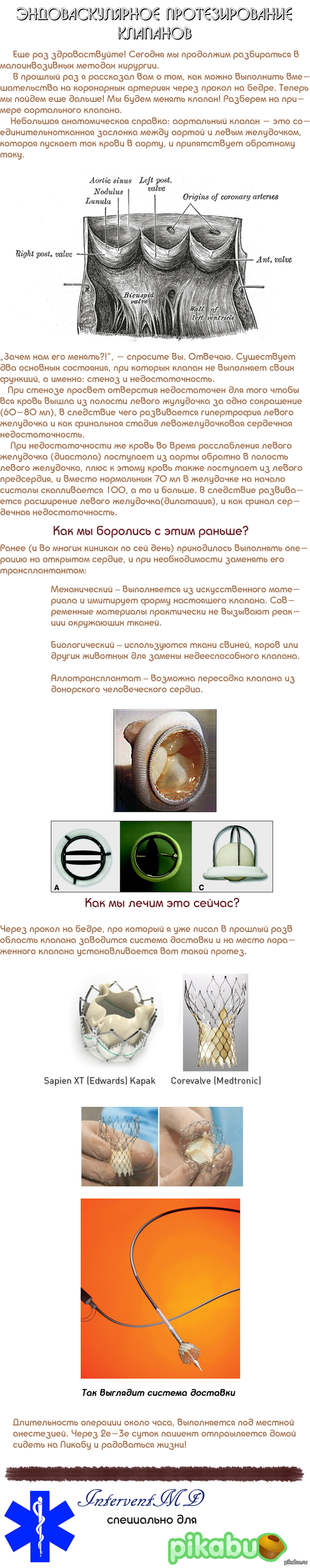          .    .  : <a href="http://pikabu.ru/story/interventsionnaya_kardiologiya_2677116">http://pikabu.ru/story/_2677116</a>