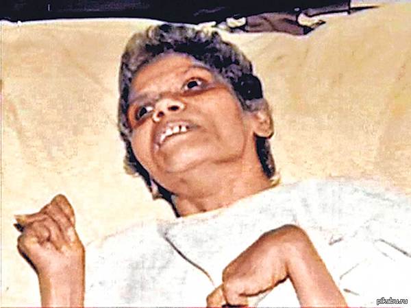    ,  42           http://www.hindustantimes.com/india-news/nurse-aruna-shanbaug-dies-in-mumbai-s-kem-hospital-after-remaining-in-coma-for-42-years/article1-1348294.aspx