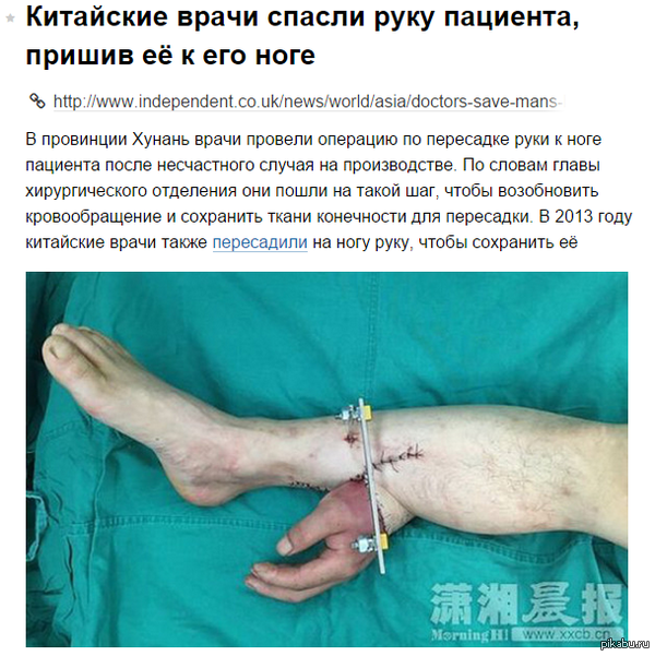     ,      http://www.independent.co.uk/news/world/asia/doctors-save-mans-hand-by-grafting-it-on-to-his-leg-for-a-month-10399667.html