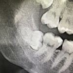 CHLH or not CHLH? That is the question… - My, Dentistry, Extraction of teeth, Teeth, Wisdom tooth, Maxillofacial Surgery, Surgeon, The medicine, Doctors, Longpost