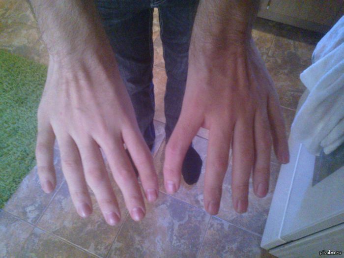 Перепонки между пальцами у мужчин. Полидактилия верхних конечностей.