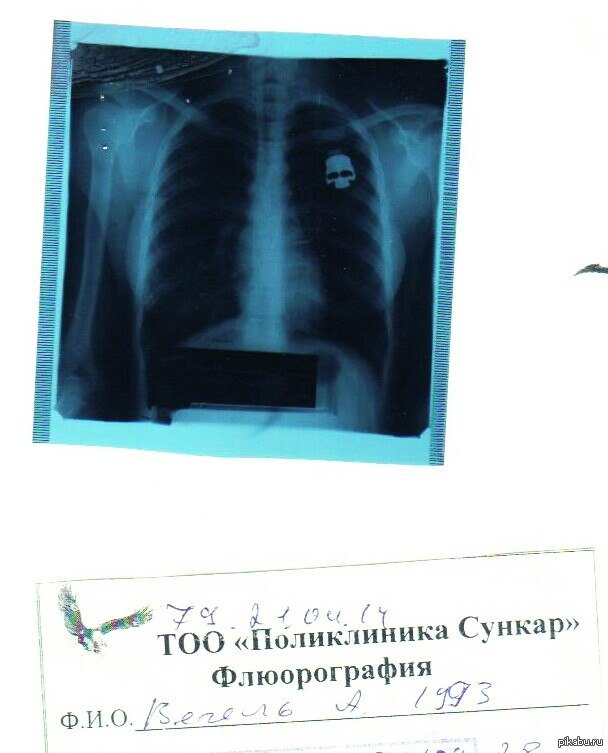 Рентген или флюорография