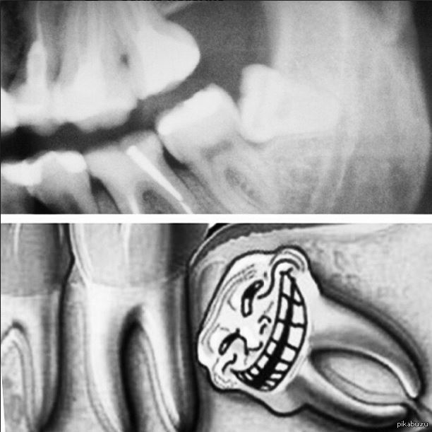 Зуб мудрости смешные картинки