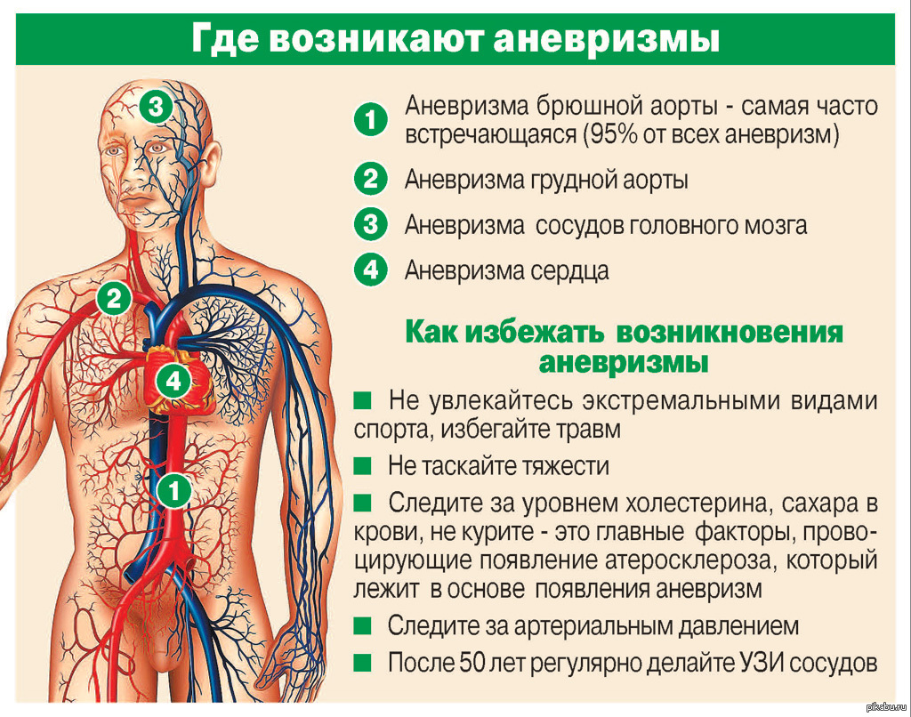 Сосуды мозга лечение. Аневризме головного мозга.