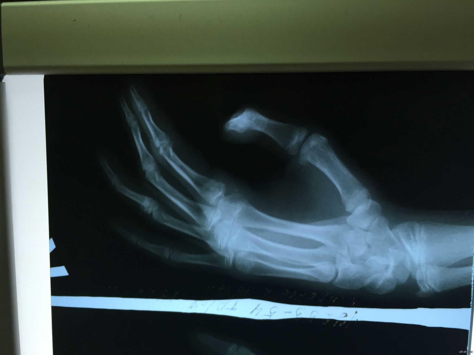 6 недель перелом. Рентгеновский снимок перелома. Перелом руки снимок рентген.