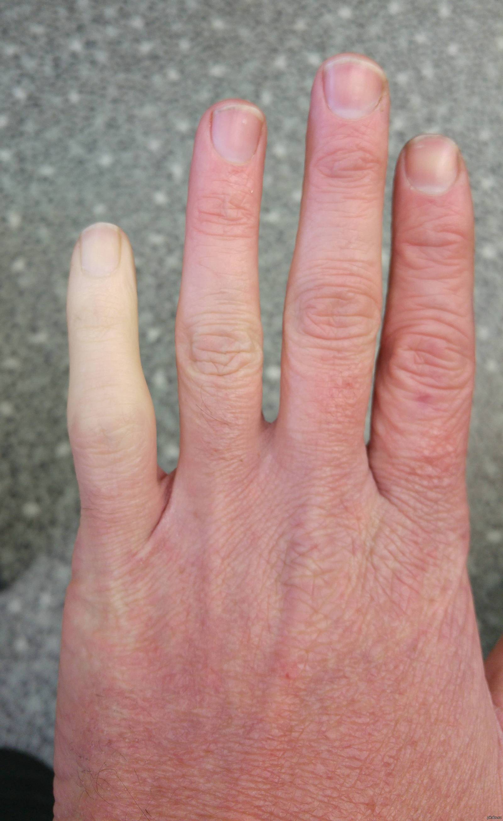 Перелом среднего пальца на руке