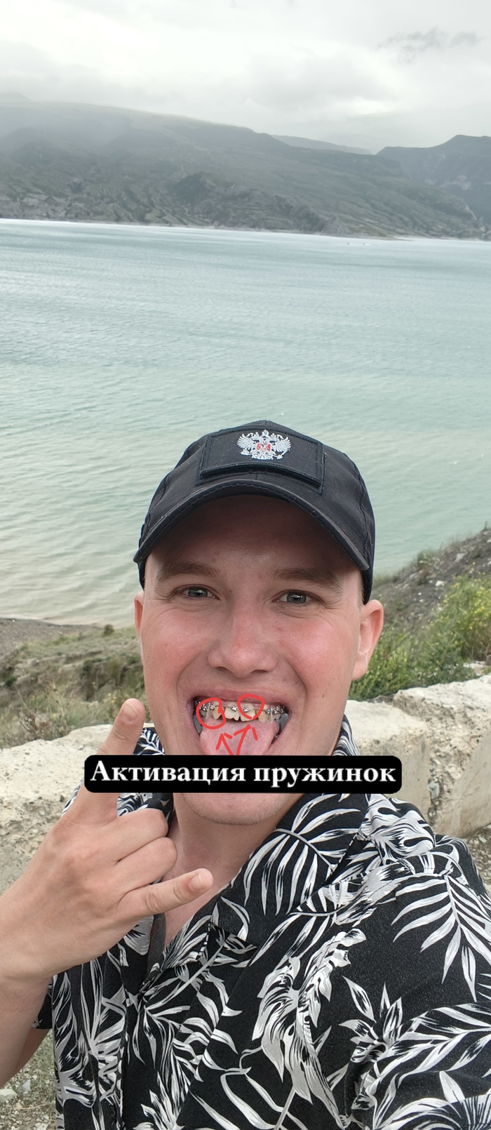 Добавляется, что-то в виде пломб на дугу