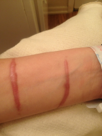 <a href="https://en.wikipedia.org/wiki/Hypertrophic_scar#/media/File:Hypertrophic_scar_-4_months_after_incident-_2013-04-05_00-46.jpg" target="_blank" rel="nofollow noopener">Фото: Cgomez447</a>