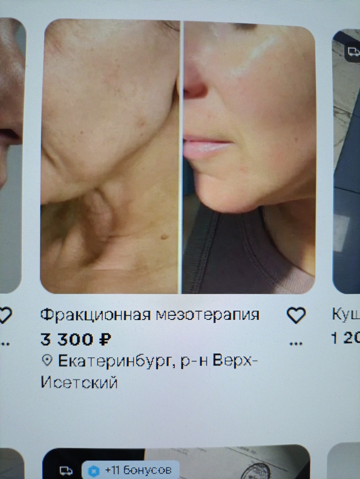 Мезотерапия
